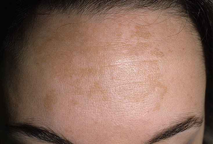 Причины появления пигментных пятен на коже